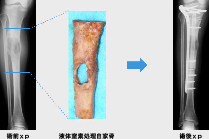 骨 軟骨腫瘍班 整形外科教室 慶應義塾大学医学部整形外科学教室