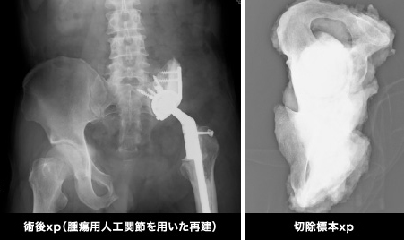 骨 軟骨腫瘍班 整形外科教室 慶應義塾大学医学部整形外科学教室